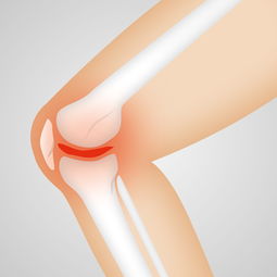中药方治疗膝关节骨关节炎