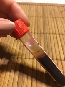 深圳哪里做全飞秒手术好一点？