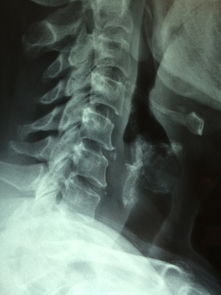 郑州肿瘤医院贲门治疗评估
