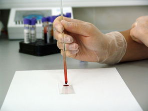 血小 platelet减少是咋回事？医生用大白话给你讲明白