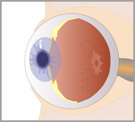 红眼病用什么敷眼，科学敷眼法助力康复